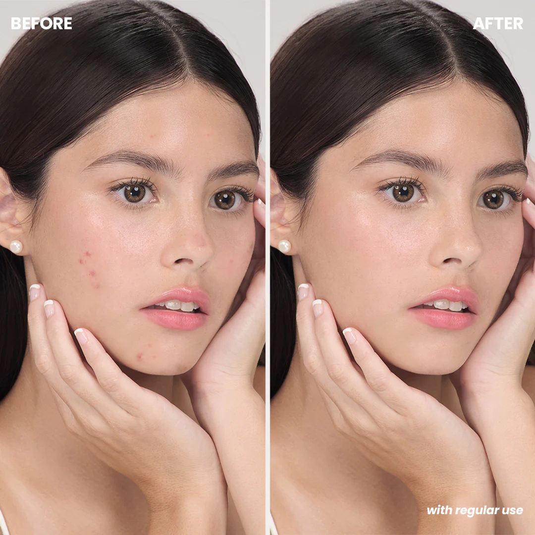 Luxe Organix Miracle Solutions Acne Derm+ Pimple Corrector 20g - Image 5