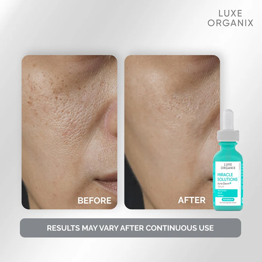 Luxe Organix Miracle Solutions Acne Derm+ Serum - Image 3